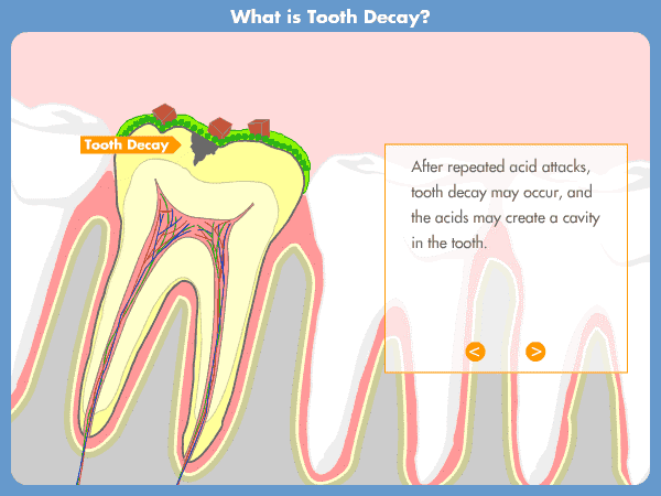 tooth-decay-acid-attack-holistic-dentistry-ph-levels