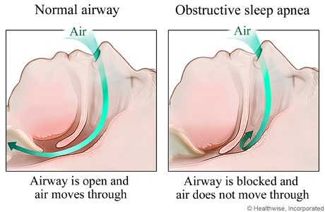 obstructive-sleep-apnea-holistic-dentistry
