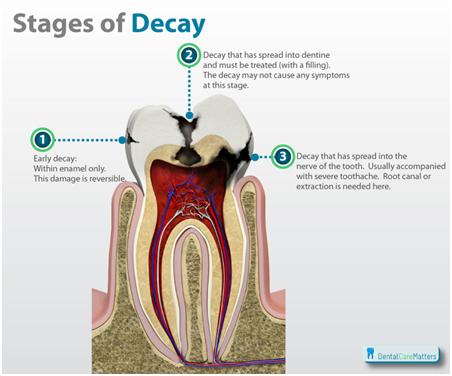 Stages-of-tooth-decay