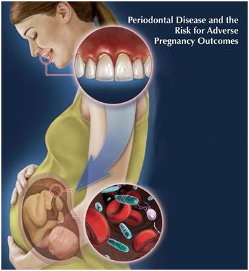 Pregnancy Gum Disease